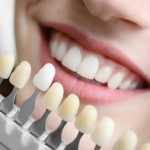 Close-up of a smiling mouth with a dental shade guide showing tooth color shades next to the teeth in a row of tabs