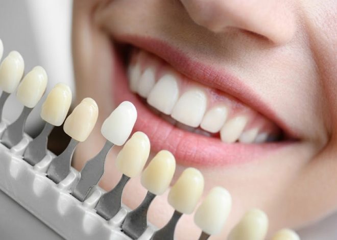 Close-up of a smiling mouth with a dental shade guide showing tooth color shades next to the teeth in a row of tabs