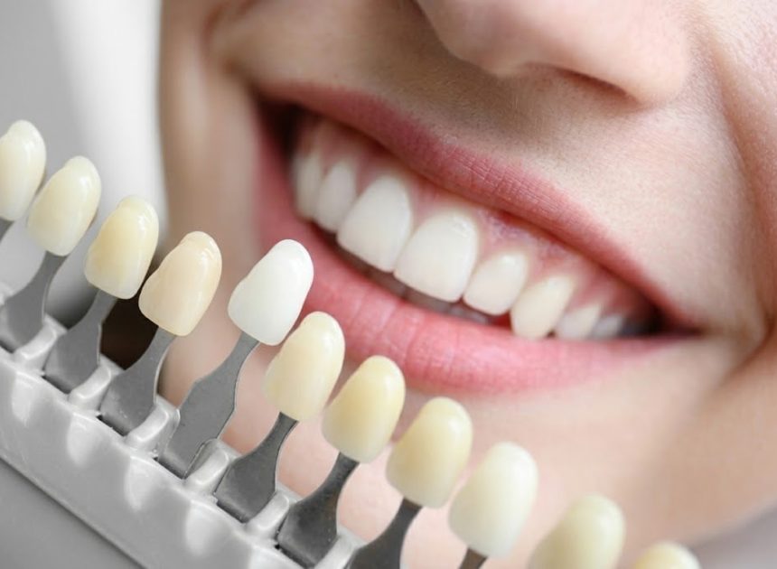 Close-up of a smiling mouth with a dental shade guide showing tooth color shades next to the teeth in a row of tabs