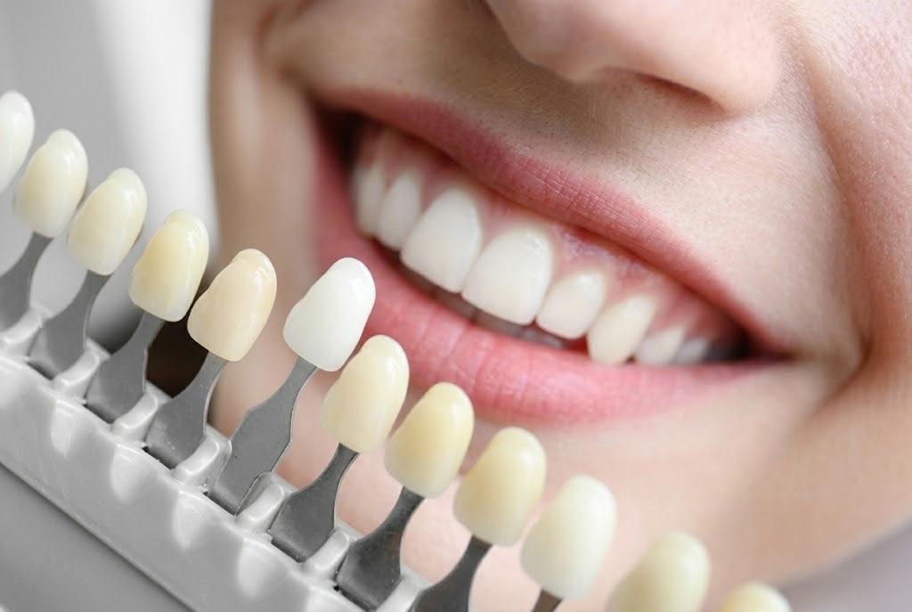 Close-up of a smiling mouth with a dental shade guide showing tooth color shades next to the teeth in a row of tabs