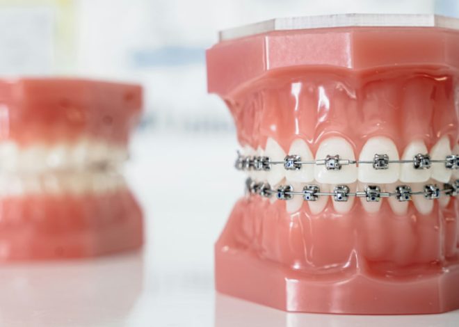 Dental model showing braces on both jaws with brackets and wires for orthodontic treatment demonstration