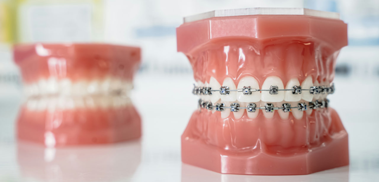 Dental model showing braces on both jaws with brackets and wires for orthodontic treatment demonstration